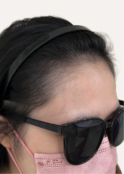 紋髪濃密案例_1