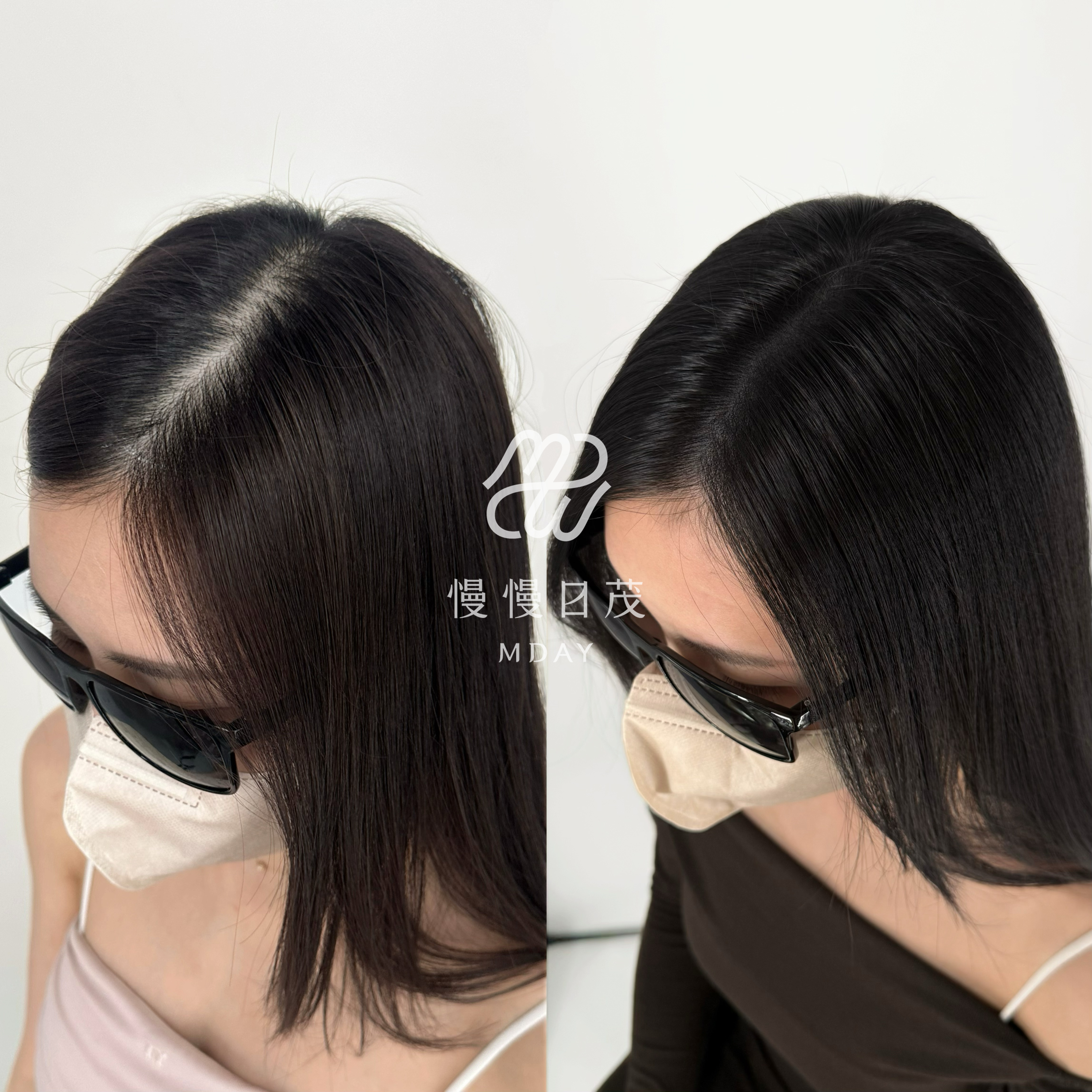 女性後腦勺填補
