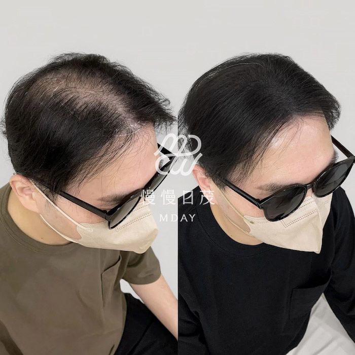 男性頭頂填補