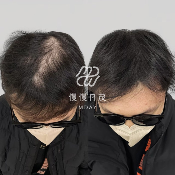 男性頭頂填補