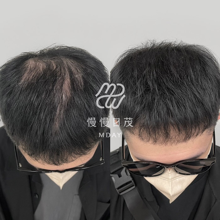 男性頭頂填補
