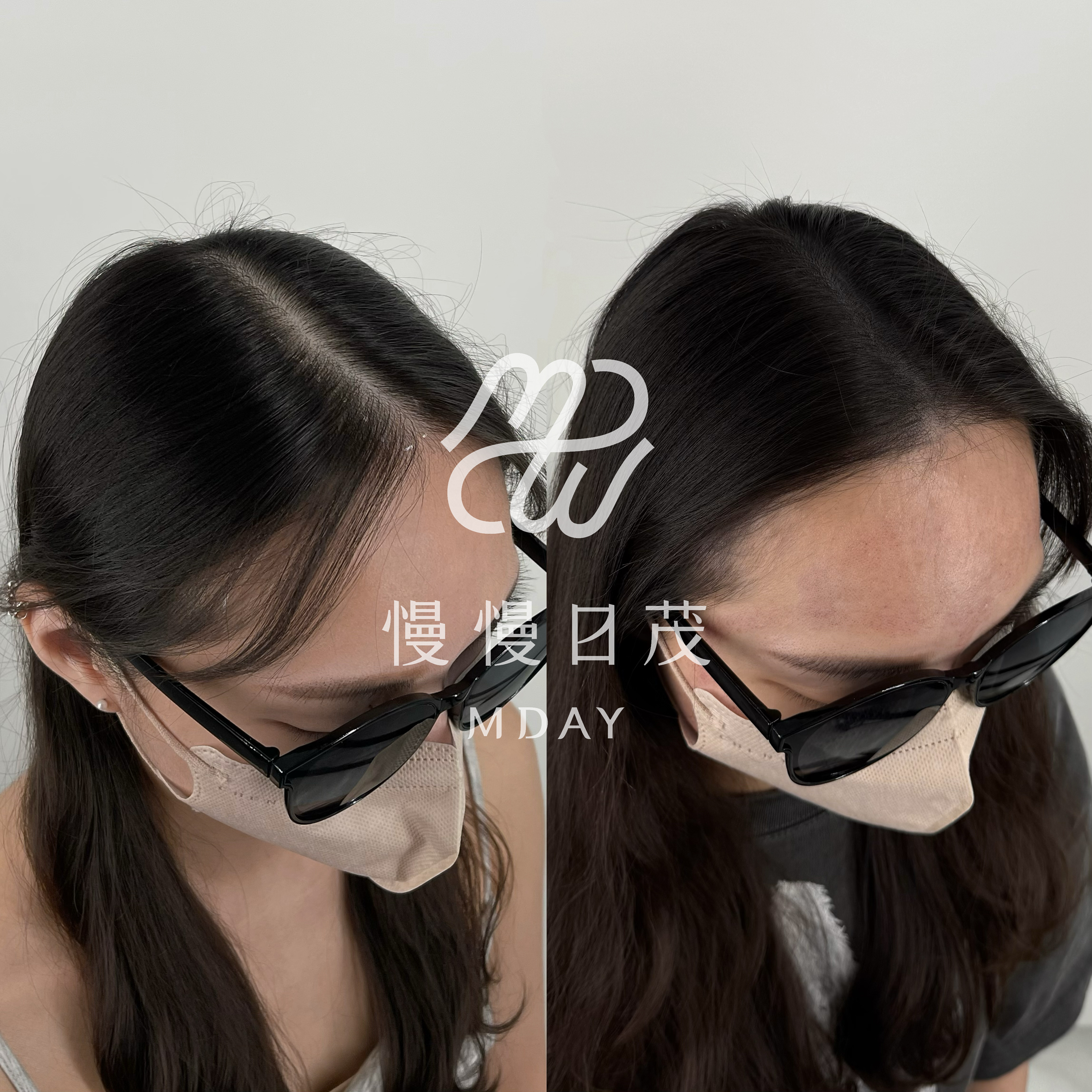 女性分線填補