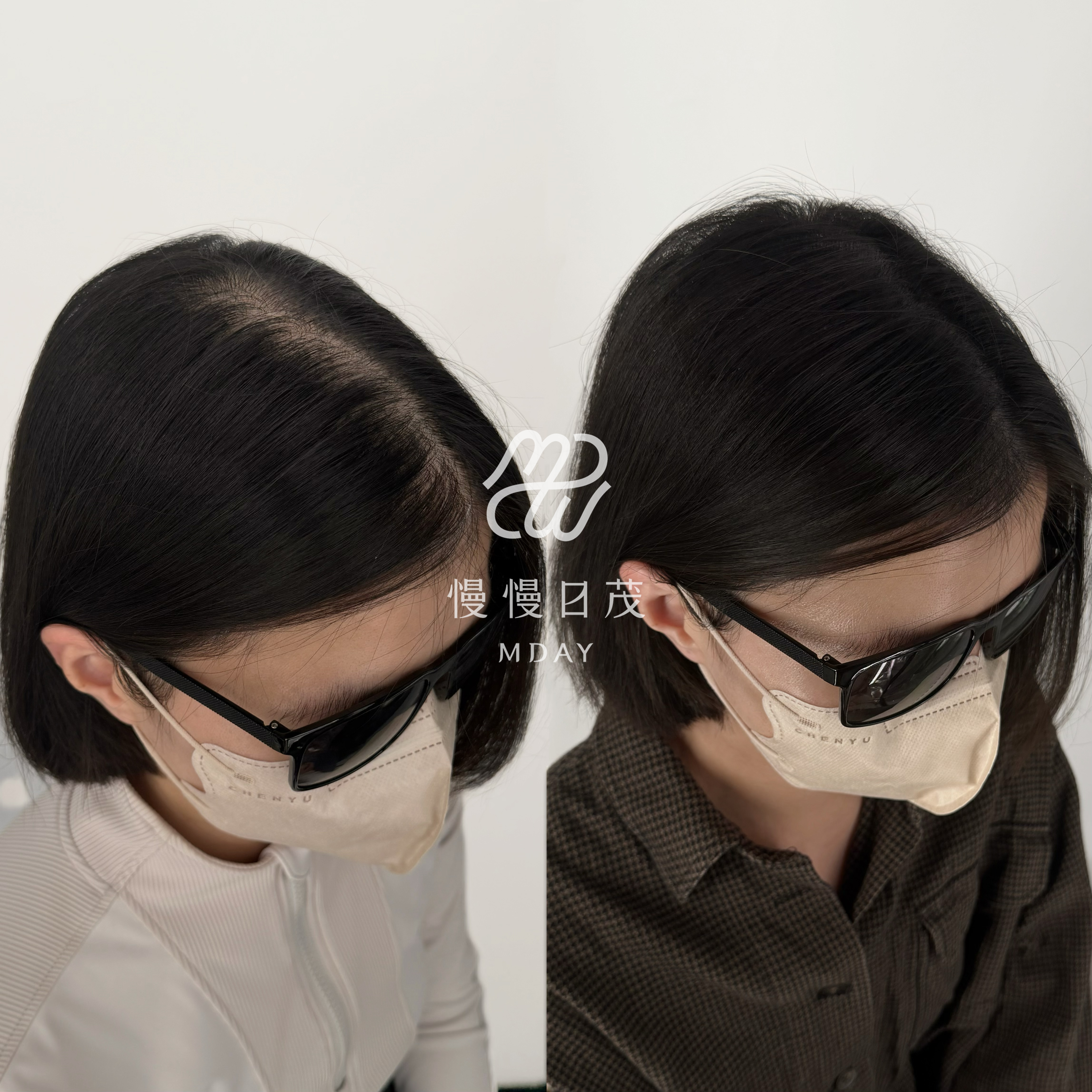 女性分線填補
