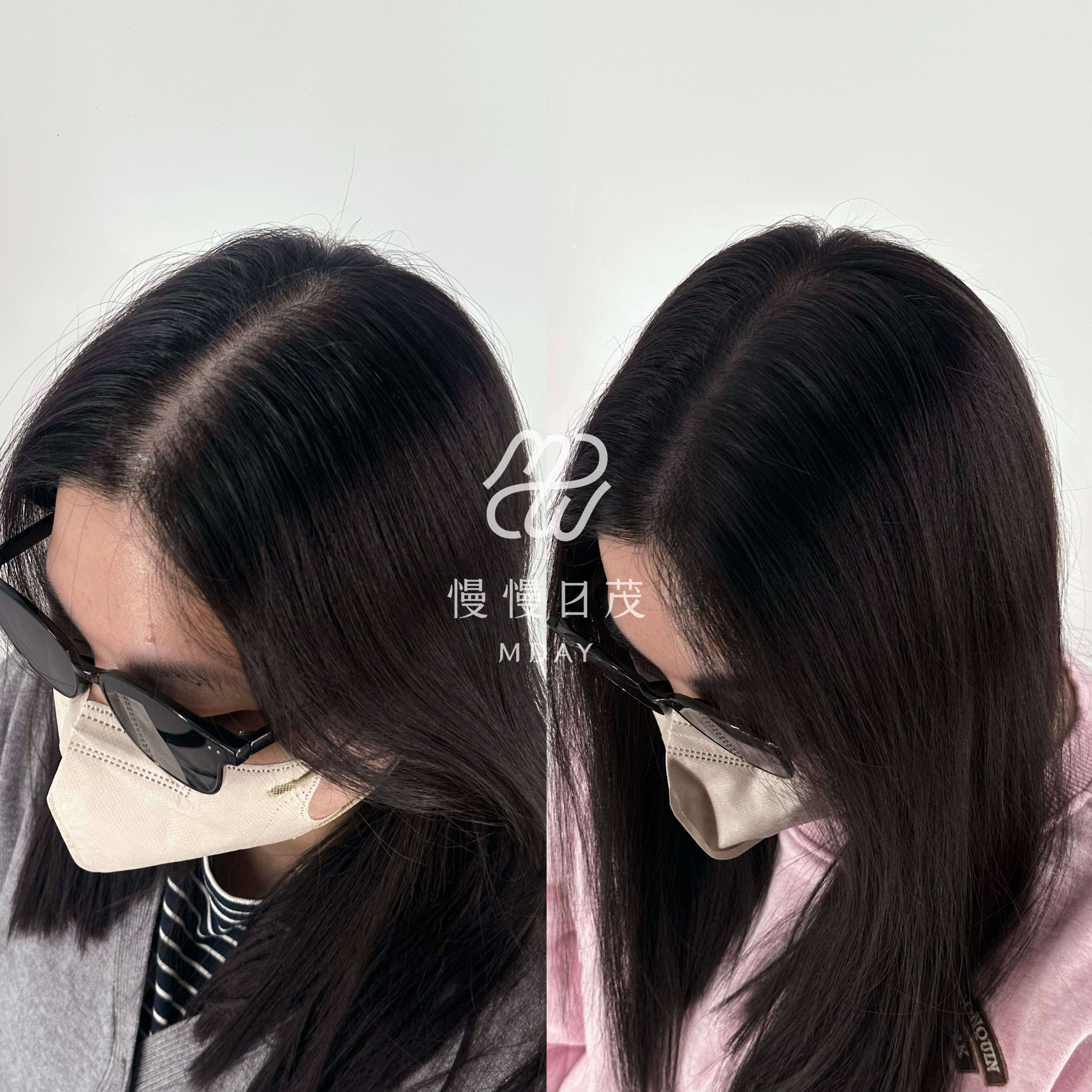 女性分線填補
