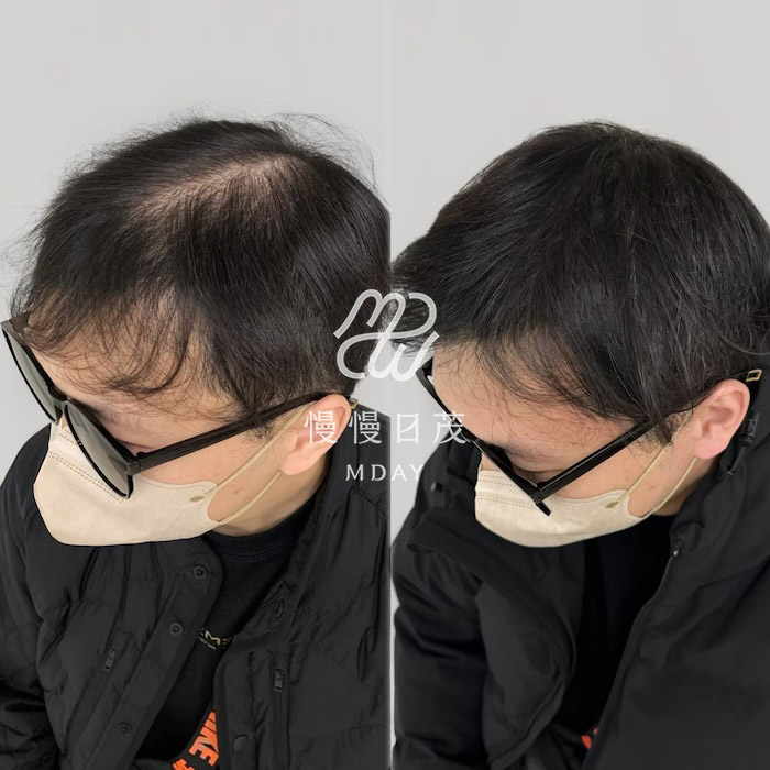 男性分線填補