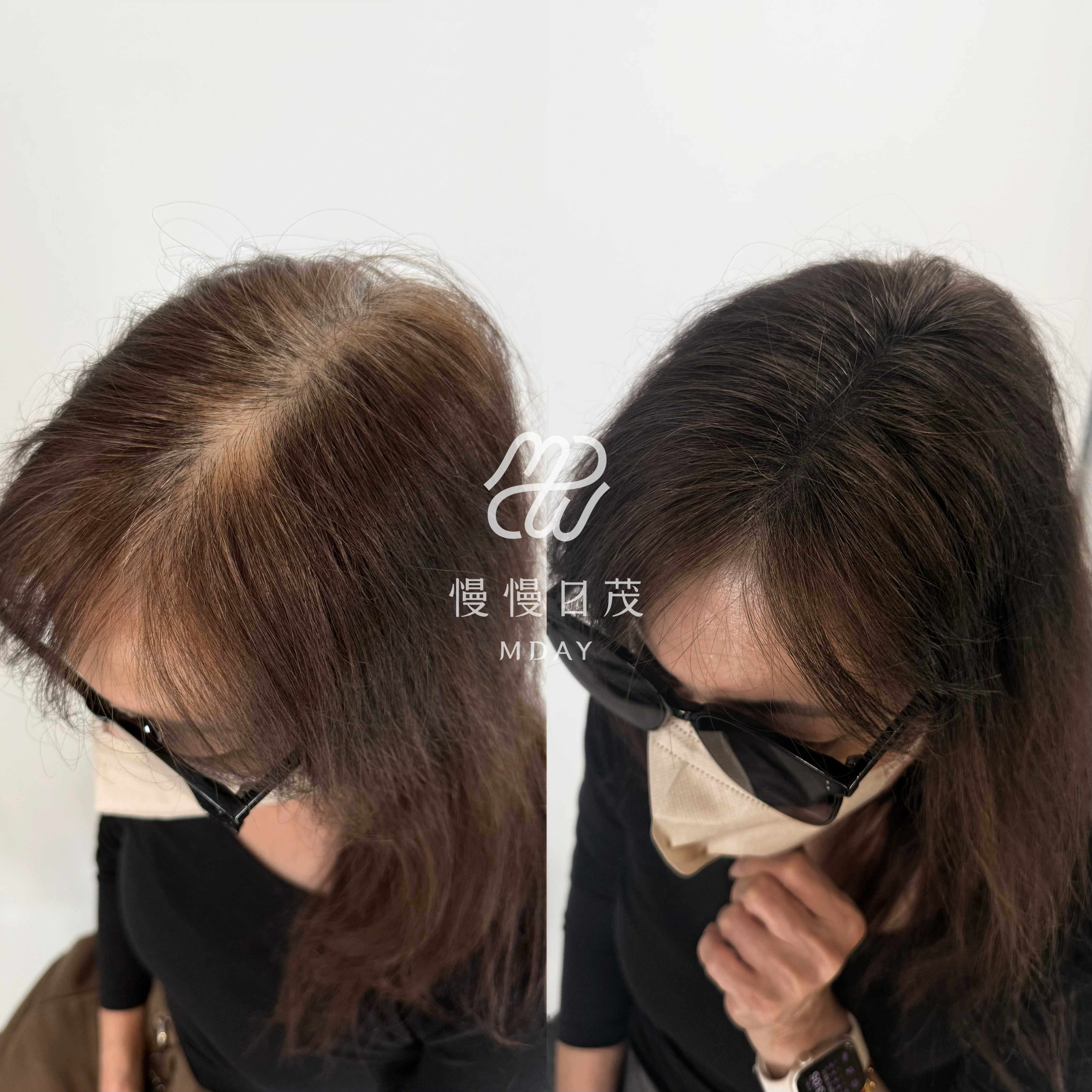 女性分線填補
