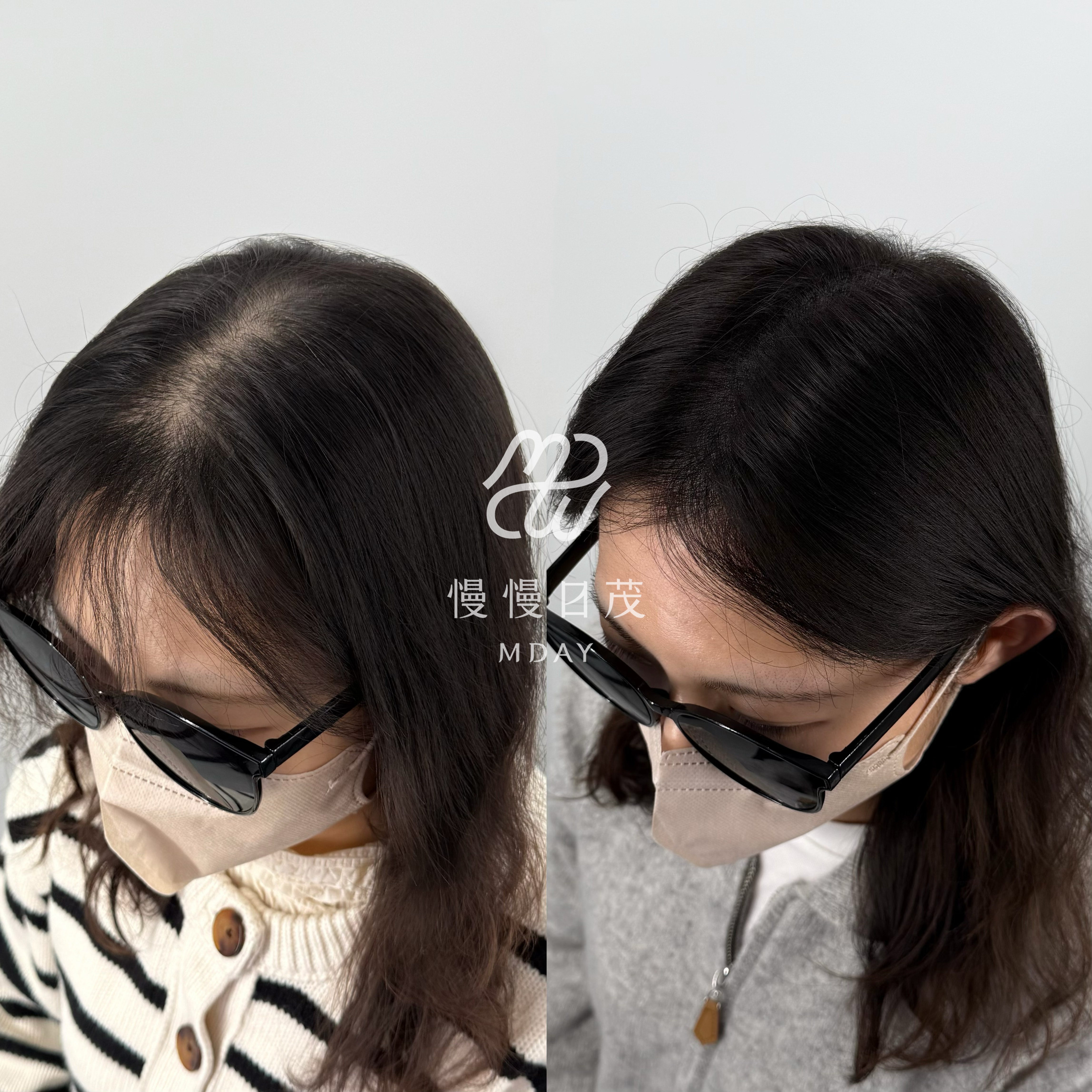 女性分線填補