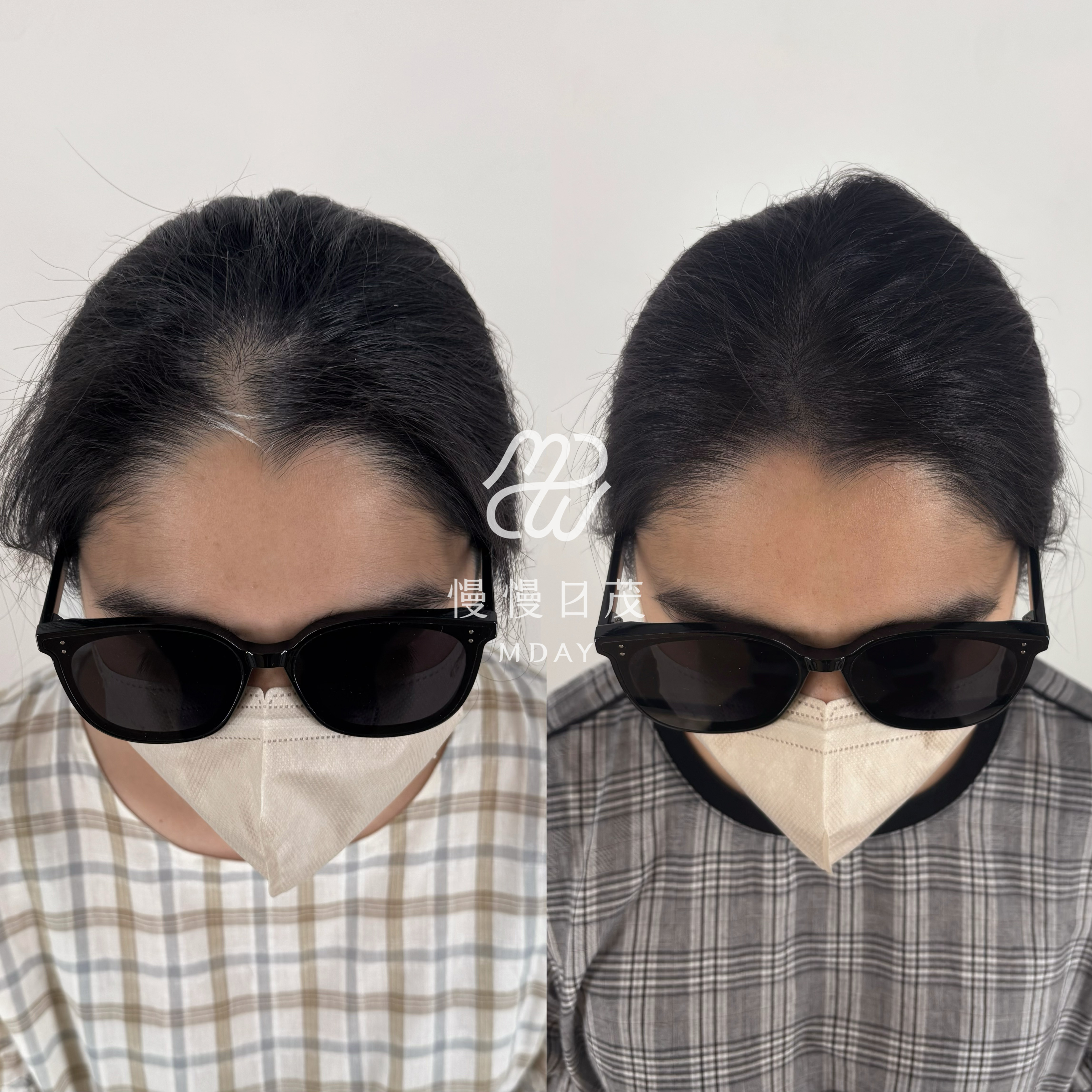 女性分線填補