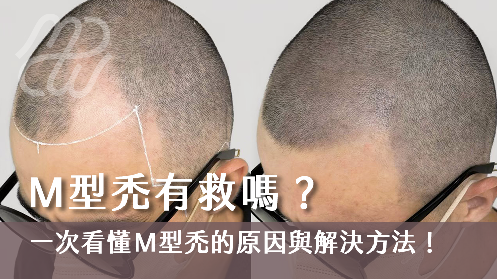 M型禿有救嗎？一次看懂Ｍ型禿的原因與解決方法！