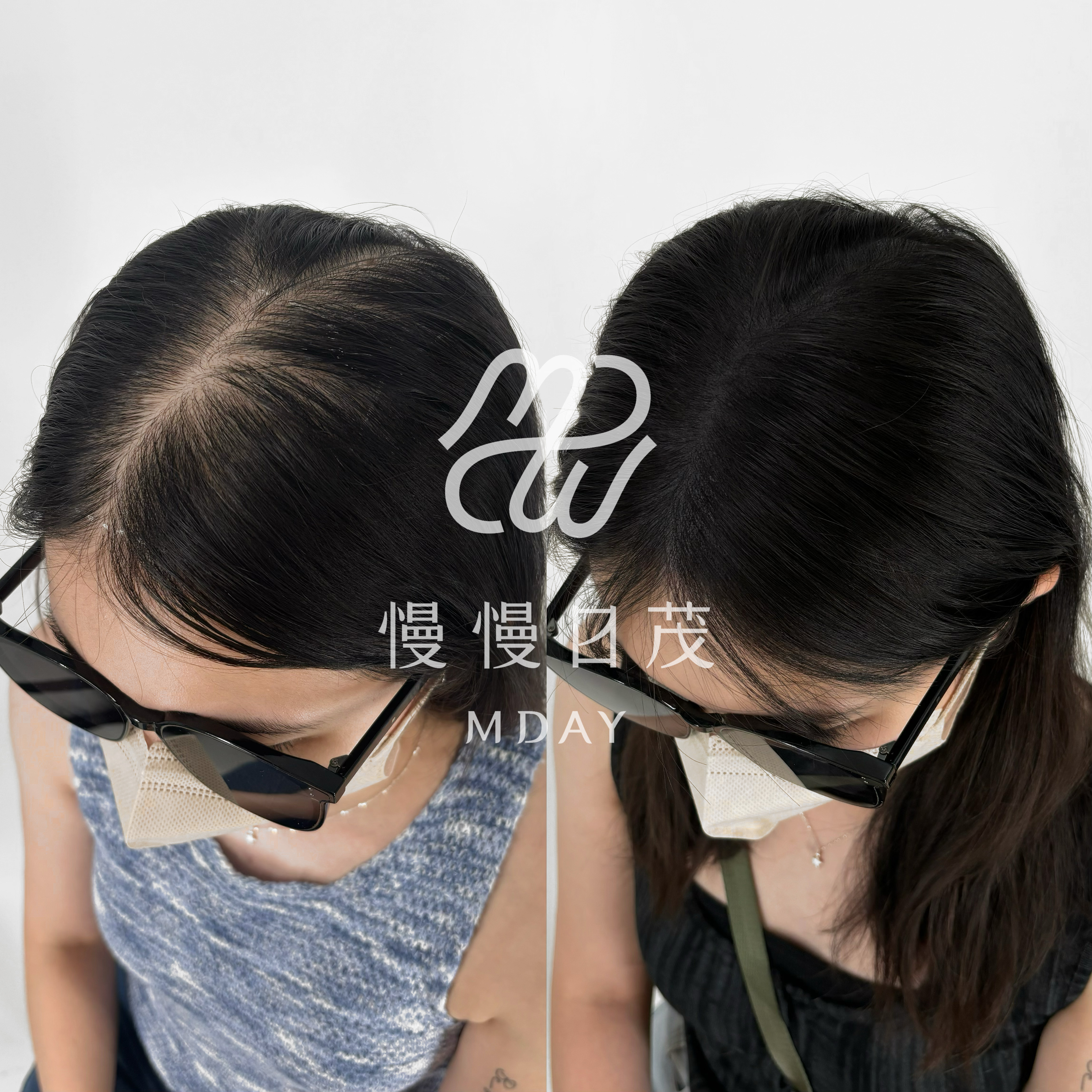 女性頭頂填補