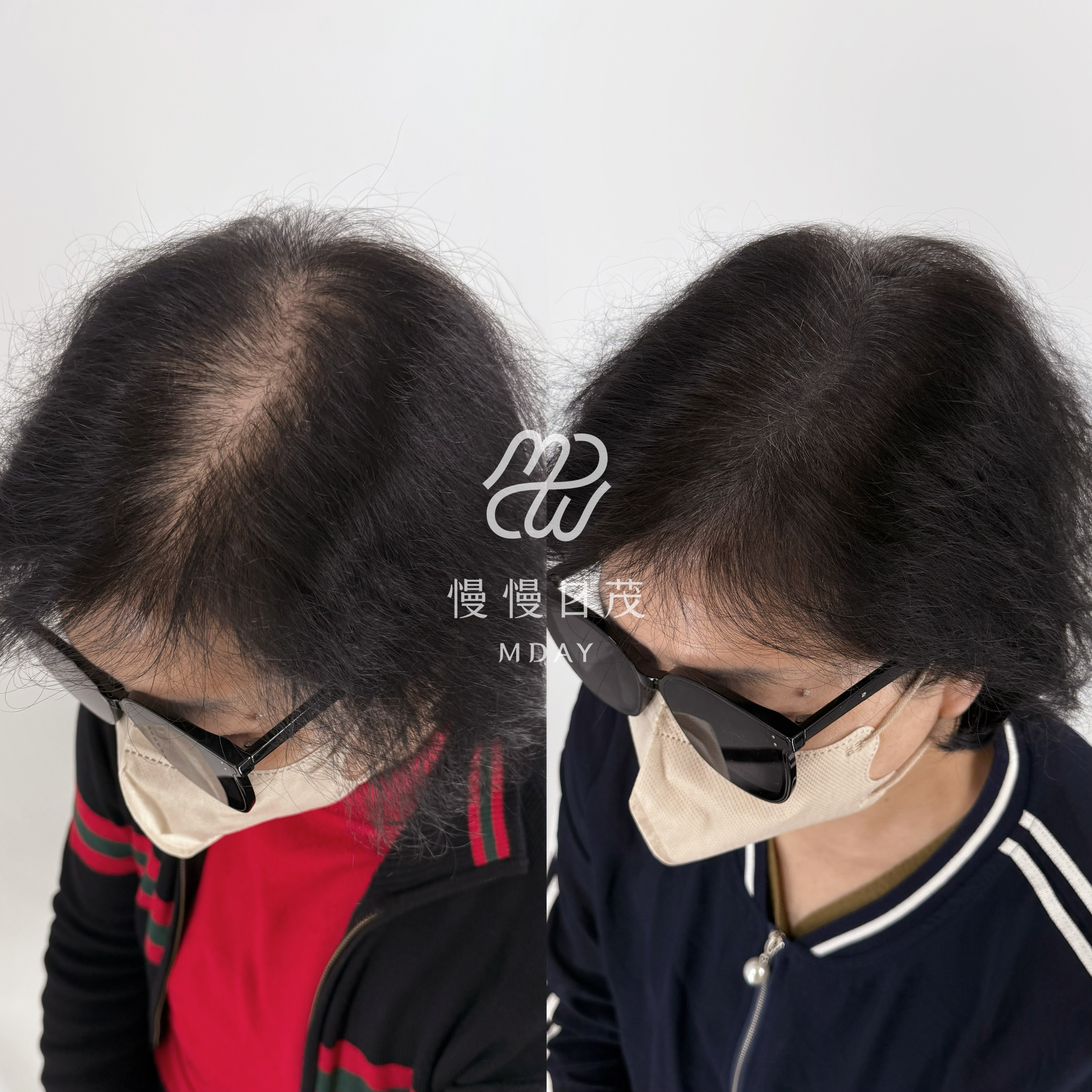 女性頭頂填補